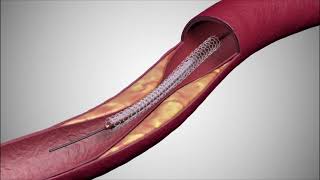 Animatie implantare de stent  Dr Pretorian  Spital Medicover  tel 0376448869 [upl. by Clapp]