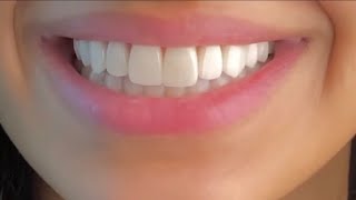 ღ your teeth are literally perfect  veneers procedure 💉 [upl. by Lazare202]