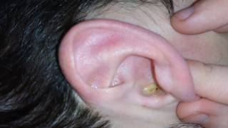 Melting earwax with Otex [upl. by Erik683]