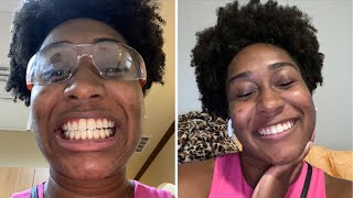 BRACES REMOVAL UPDATE [upl. by Kathryne]