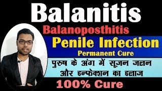 Treatment Of Balanitis  पुरुष के अंग में सूजन जलन और इन्फेक्शन का इलाज  Balanitis  Balantis [upl. by Naruq]