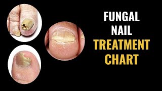 Fungal Nail Treatment Options Chart [upl. by Aniral7]