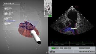 HeartWorks Pulmonary Embolism [upl. by Nnyleimaj]