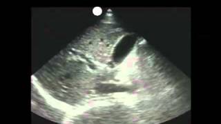 How To Gallbladder Ultrasound Part 1  Introduction Case Study Video [upl. by Mcquade629]