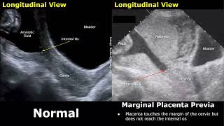 Obstetric Ultrasound Normal Pregnancy Vs Placenta Previa  LowLying Marginal Partial Complete [upl. by Arema]