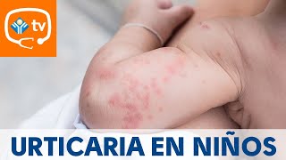 Urticaria en niños ¿cómo se produce ¿Tiene importancia [upl. by Nnyllaf]