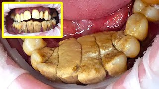 47 yo Males Teeth Gigantic Tartar Removal  Scaling [upl. by Ressler]