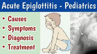 Acute Epiglottitis In Children Causes Clinical features Diagnosis and Management [upl. by Harding]