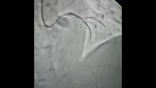 Stenting of Critical LAD Stenosis  Dr CR Rawat  Dr Rajat Rawat  Best Cardiologist in Agra [upl. by Lowenstern]