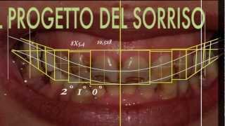 Cambiare laspetto del sorriso con faccette dentali  SMILE DESIGN [upl. by Malley]