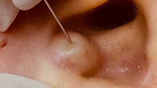 NEW Large Cyst Removal BEST POPS Compilation  w relaxing music amp an OOZ GALORE [upl. by Thea320]