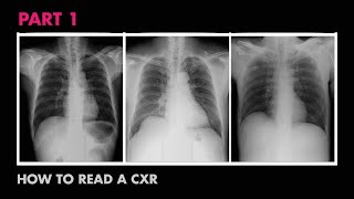 Anatomy of a Chest XRay  How to Read a Chest XRay Part 1 [upl. by Rigdon]