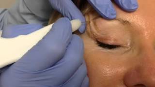 Watch As Dr Dev Patel Walks You Through a Plexr Blepharoplasty Treatment [upl. by Dwane372]