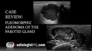 Ultrasound of Pleomorphic Adenoma of the Parotid Gland [upl. by Afira836]