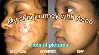 HOW I CLEARED MY ACNE  My Skin Journey no accutane [upl. by Alien]