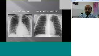 Pedicardio classes on Pulmonary stenosis Dx and Rx incl Balloon valvuloplasty by Dr Premsekar [upl. by Sulakcin]