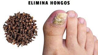 Elimina los hongos de las uñas en segundos ¡como un borrador ¡El mejor remedio natural eficaz [upl. by Aubine532]