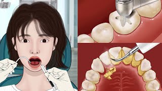 ASMR Dental Treatment Animation 🦷 Satistfying Tartar amp Caries Removal  Mengs Stop Motion [upl. by Jarus]