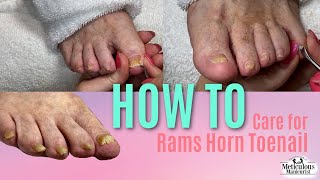 How to Pedicure Nail Care on Rams Horn Toenail [upl. by Schober]