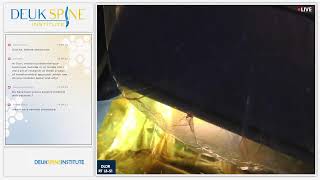 Watch Live Back Treatment Deuk Laser Disc Repair  Lumbar  RT L3S1 [upl. by Eillo]