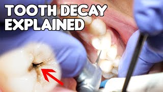 Tooth Decay Cavity Explained  Cavities vs Fillings vs Dental Caries [upl. by Liuqnoj]