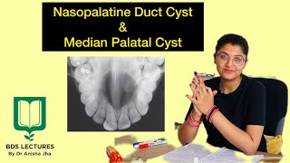 Nasopalatine Duct Cyst amp Median Palatal Cyst Lecture 15 Cysts of Orofacial Region ORAL PATHOLOGY [upl. by Aratahs86]