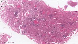 Miliary Tuberculosis  Spleen  Histopathology [upl. by Toole]