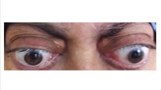 Causes of Bilateral Exophthalmos  Bilateral Proprtosis  Bulging Eyes [upl. by Okire]