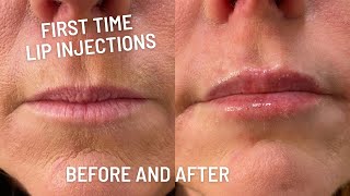 First time getting lip filler honest experience [upl. by Adrian]