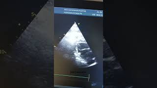 2D Echo Cardiography parasternal short axis view [upl. by Massarelli]