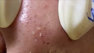 角栓 除去 blackheads removal [upl. by Arlena]