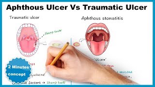 Aphthous ulcerstomatitis Vs Traumatic ulcer [upl. by Zzaj]