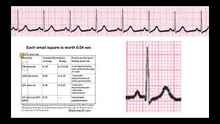 How to Determine Intervals amp Segments on EKG EXPLAINED [upl. by Gathard666]