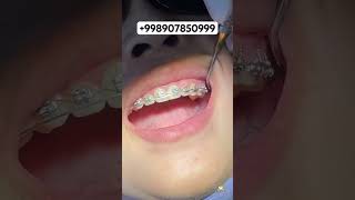 Breket Quva Shahrida uzbekistan dentist fergana quva aesthetic satisfying [upl. by Douglass]