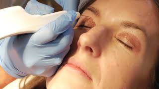 Non surgical blepharoplasty with PLEXR [upl. by Shayn]