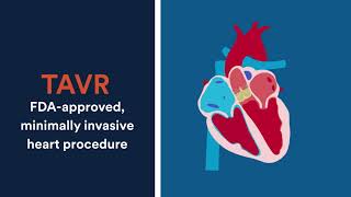 What to know about Transcatheter Aortic Valve Replacement [upl. by Hayidah]