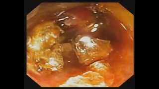 Direct Peroral Cholangioscopy with Electrohydraulic Lithotripsy for Cystic Duct Stone [upl. by O'Gowan]