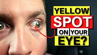 Yellow SPOT On Your Eye  Pinguecula Explained [upl. by Cupo]