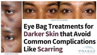 Eye Bags Treatments for Dark Skin that Avoid Common Complications Like Scarring [upl. by Xonk377]