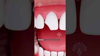 How Does Bonding Fix a Chipped Tooth shorts tooth  Creativelearning3d [upl. by Aitnauq]