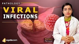 Viral Infections  Mumps  Pathology Video Lectures  Medical VLearning  sqadiacom [upl. by Notlehs305]