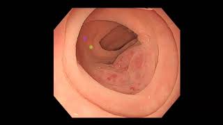 Arteriovenous malformations of the colon evaluated using hemodynamic parameters in color Doppler EUS [upl. by Yatnuahs]