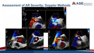 Joint Echo Conference Aortic Insufficiency [upl. by Nilat]