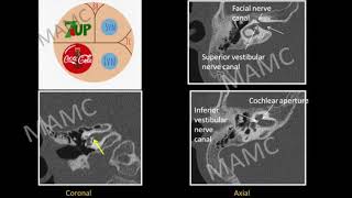 TMT Inner Ear by Dr Jyoti Kumar  Part II [upl. by Yenitsed]