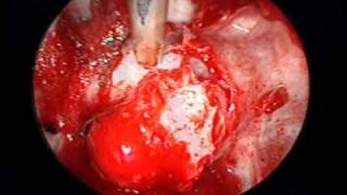 pituitary adenoma endoscopic endonasal Demo [upl. by Seward]