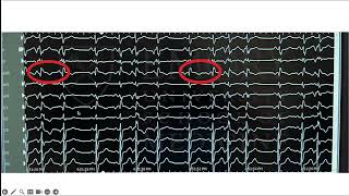 Mitral Annular Disjunction and Arrhythmias [upl. by Beck]