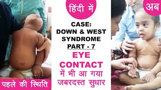 Down Syndrome amp West Syndrome Case  Part 7  EYE CONTACT में भी आ गया जबरदस्त सुधार  हिंदी मे [upl. by Mcdowell668]