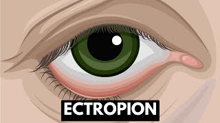 Ectropion Causes Symptoms Complications And Treatment [upl. by Joo]