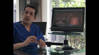 Mamoplastia de reducción  Dr Ivan Santos  Cirugía plástica en Colombia [upl. by Yendys505]