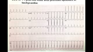 SVT supra ventricular tachycardia ekg ecg electrocadiogram Dr BenZur [upl. by Serge]